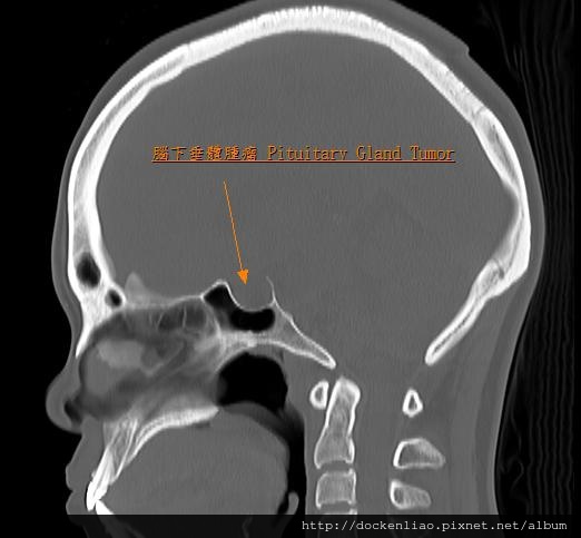 腦下垂體內視鏡手術 劉耿僚 pituitary gland surgery Dr. Ken-Liao Liu