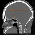 腦下垂體內視鏡手術 劉耿僚 pituitary gland surgery Dr. Ken-Liao Liu