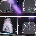 腦下垂體內視鏡手術 劉耿僚 pituitary gland surgery Dr. Ken-Liao Liu