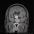 MRI cor measure.jpg