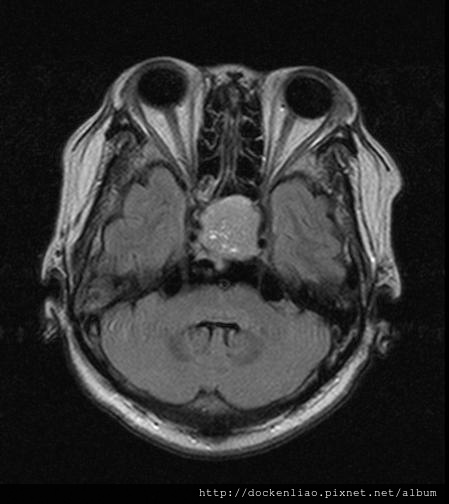 pituitary gland tumor MRI axi1.jpg