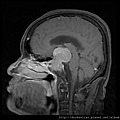 pituitary gland tumor MRI sag1.jpg