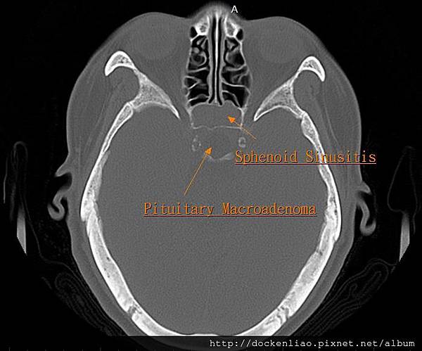 Pituitary macroadenoma CT axi1.jpg