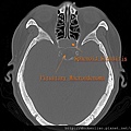 Pituitary macroadenoma CT axi1.jpg