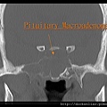 Pituitary macroadenoma CT cor1.jpg