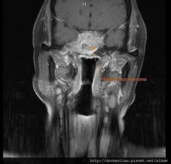 Pituitary macroadenoma MRI cor1.jpg