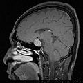 MRI PITUITARY GLAND TUMOR SAGITTAL 6.jpg
