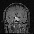 MRI PITUITARY GLAND TUMOR CORONAL 5.jpg