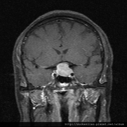 MRI PITUITARY GLAND TUMOR CORONAL 9.jpg