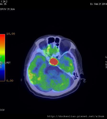 PITUITARY GLAND TUMOR PET CT AXIAL.jpg