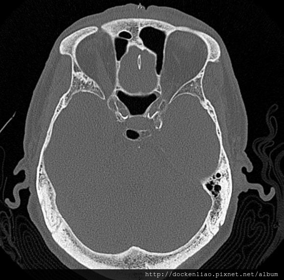 2014-02 Pituitary gland tumor CT axial 2