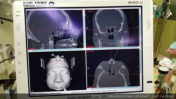 2016-04 內視鏡點腦導航系統 navigation pituitary gland tumor 腦下垂體腫瘤 內視鏡手術