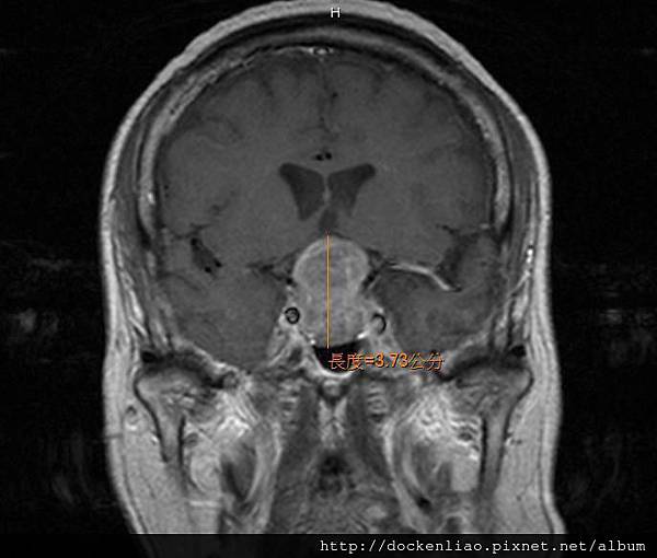 pituitary macroadenoma MRI cor 1.jpg