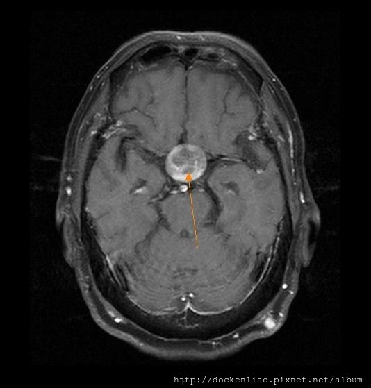 Pituitary macroadenoma MRI dark fluid t1 tse tra fu axi1.jpg