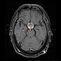 Pituitary macroadenoma MRI dark fluid t1 tse tra fu axi1.jpg