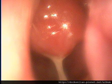 2015-04-13 023 NP tumor.jpg