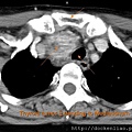 CT thyroid tumors axi4.jpg