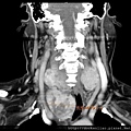 CT thyroid tumors 10 cm cor3.jpg