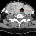 CT thyroid tumors axi1.jpg