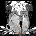 CT thyroid tumors 10 cm cor.jpg