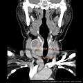甲狀腺腫瘤大於5公分，仍有可能手術傷口小於3公分完整手術單側全葉取出 thyroid tumor  more than 5 cm CT op wound 3 cm axi