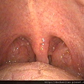 2016-04-22 030 tonsil hypertrophy.jpg