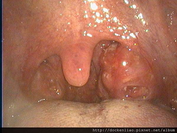 2016-03-25 Tonsil purulent big left.jpg