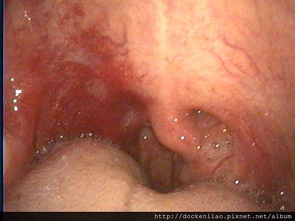 2016-05-25 014 right hemangioma lt tonsil tumor.jpg