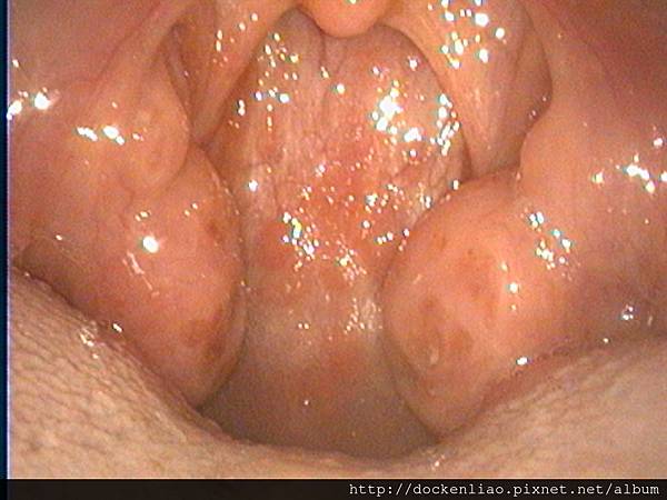 2016-05-30 053 tonsil hypertrophy.jpg