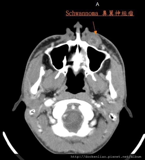 鼻翼神經瘤 nasoalveolar schwannoma