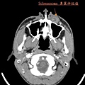 鼻翼神經瘤 nasoalveolar schwannoma
