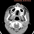 鼻翼神經瘤 nasoalveolar schwannoma