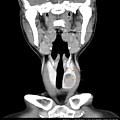 thyroid tumor calcified CT cor 2.jpg