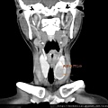 thyroid tumor calcified CT cor 1.jpg
