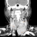 thyroid tumor calcification CT cor2.jpg