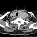thyroid tumor calcification CT axi1.jpg