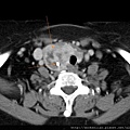 THYROID TUMOR CT AXI 1.jpg