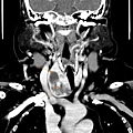 THYROID TUMOR CT COR 1.jpg