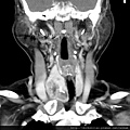 THYROID TUMOR CALCIFICATION CT COR 1.jpg