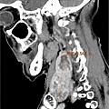 THYROID TUMOR BIL CALCIFIED SAG 1.jpg