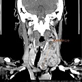 THYROID TUMOR BIL CALCIFIED COR 4.jpg