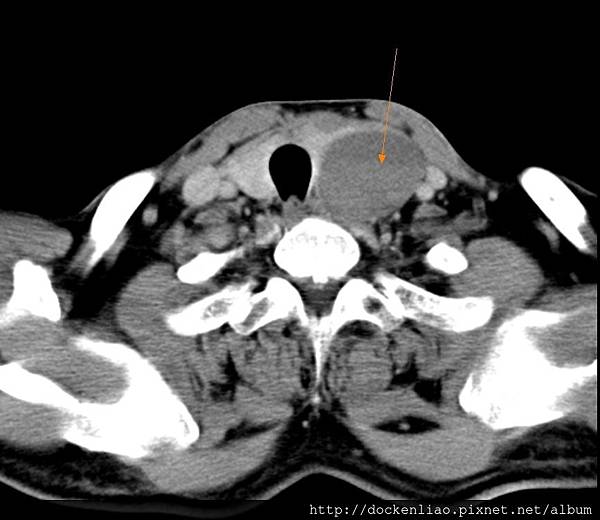 這樣臨床看似平凡無奇的甲狀腺腫，手術病理結果是甲狀腺癌！ this is THYROID CANCER !