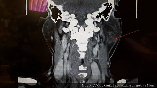 腮腺腫塊 2016-07-12 10.49.47 parotid mass CT