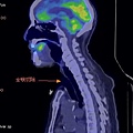 88歲 全喉切除後 卡魚刺 total laryngectomy PET CT  2016 3