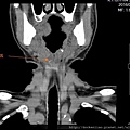 喉嚨卡魚刺 fish bone CT cor1