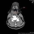 喉嚨卡魚刺 fish bone CT axi1