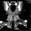 喉嚨卡魚刺 fish bone CT cor2