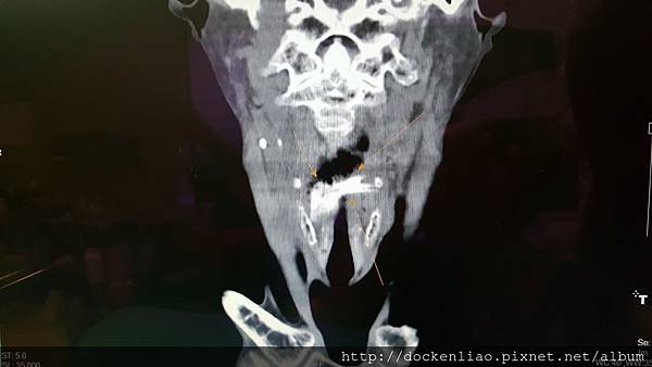 90幾歲喉嚨卡巨大骨頭一星期 2016-07-28 13.22.31