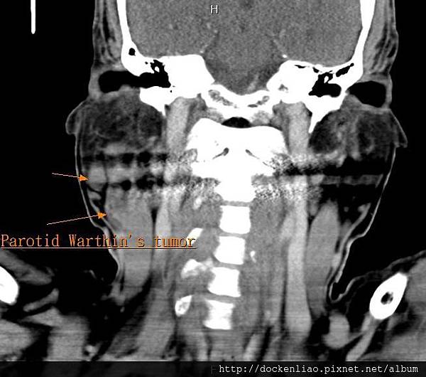 parotid warthin's tumor CT cor1.jpg