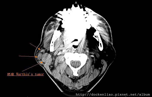 parotid warthin's tumor CT axi1.jpg